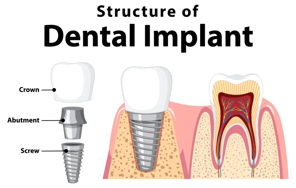 Dental Implant Screw